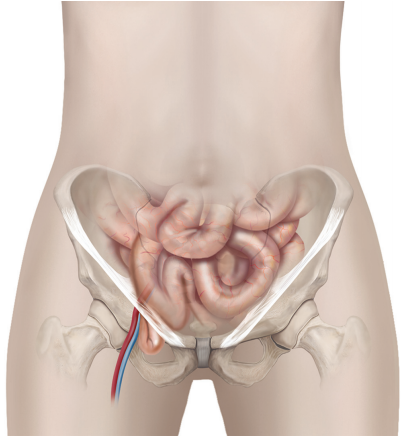 Laparoscopic repair of a strangulated femoral hernia 